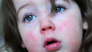 بیماری مخملک در کودکان چیست