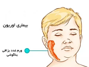 اوریون در کودکان