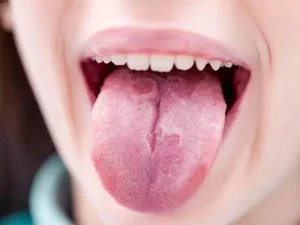 التهاب و قرمز شدن زبان کودکان