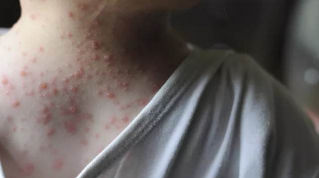 آبله مرغان یکی از انواع دانههای قرمز روی پوست کودکان