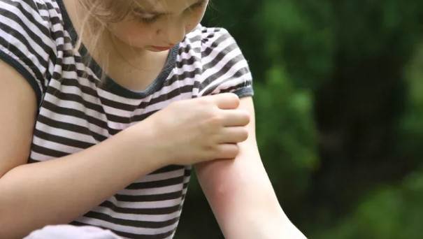 جای نیش حشرات یکی از انواع دانههای قرمز روی پوست کودکان