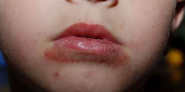 درماتیت دور دهانی یکی از انواع دانههای قرمز روی پوست کودکان