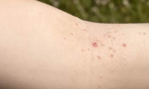 زگیل آبکی یکی از انواع دانههای قرمز روی پوست کودکان