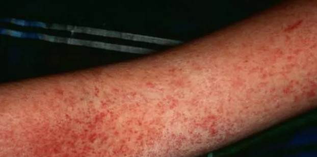 سرخک یکی از انواع دانههای قرمز روی پوست کودکان