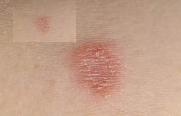 عفونت قارچی یکی از انواع دانههای قرمز روی پوست کودکان