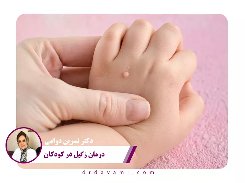 درمان زگیل در کودکان