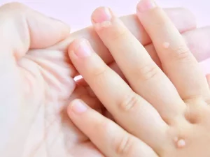 روش های درمان زگیل در کودکان