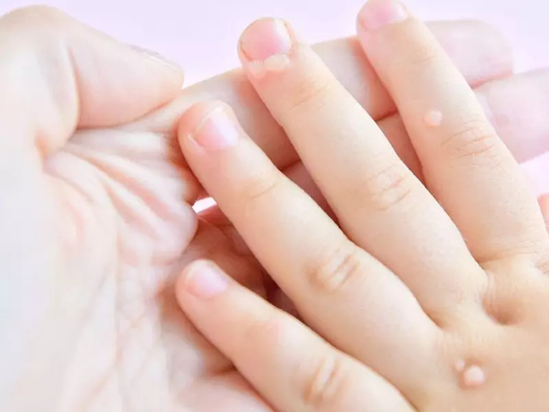 روش های درمان زگیل در کودکان