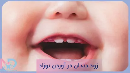 زود دندان در اوردن نوزاد