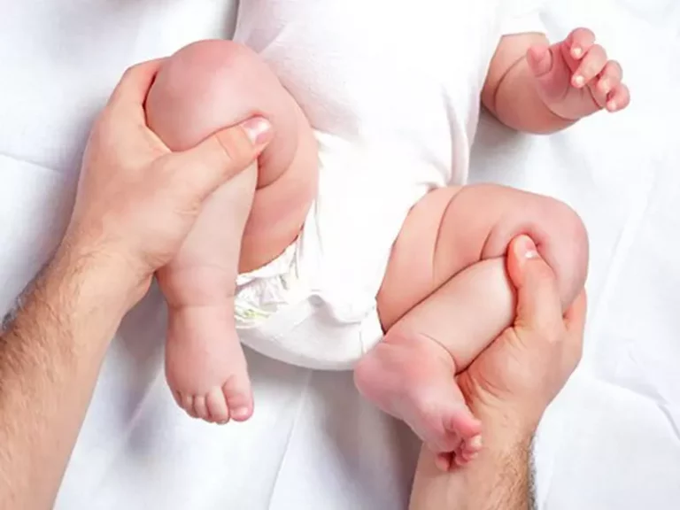 درمان دررفتگی در نوزادان