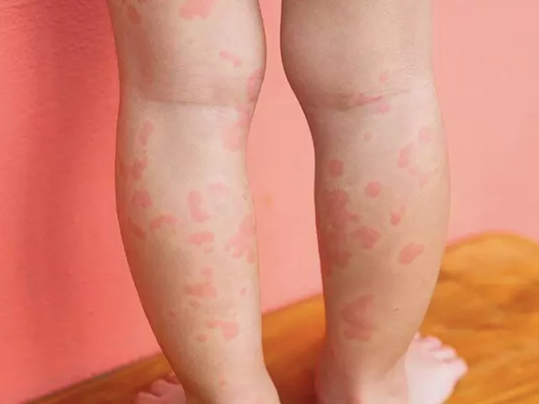 درمان کهیر در کودکان