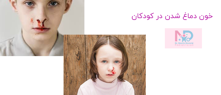 خون دماغ شدن در کودکان